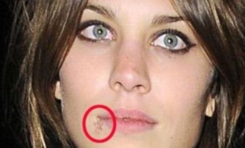 online dating herpes sufferers